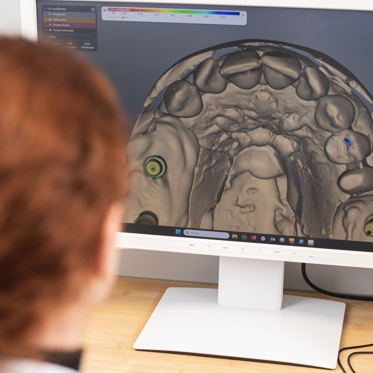 Zahntechnikerin sitzt vor dem Computer und plant mit CAD/CAM-Technologie einen Zahnersatz